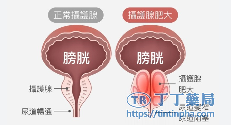 有攝護腺肥大的中老年男性 有攝護腺肥大的中老年男性