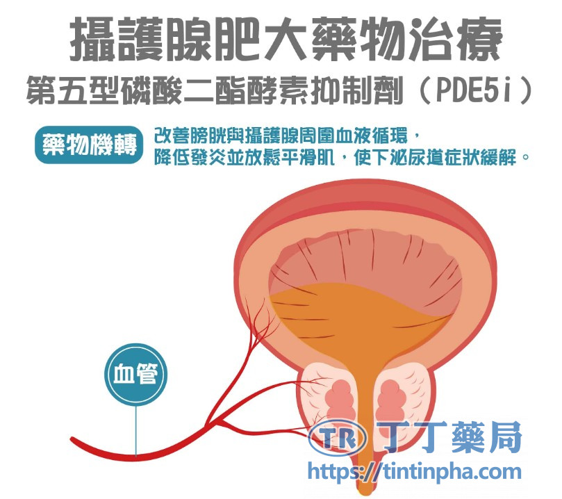 PDE5i與攝護腺肥大的關聯 PDE5i與攝護腺肥大的關聯